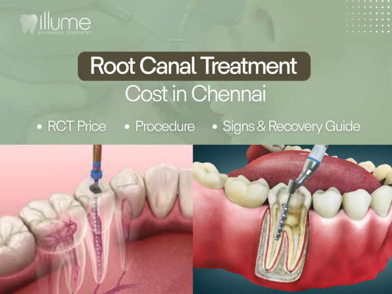 Root Canal Treatment Cost in Chennai – RCT Price, Procedure, Signs & Recovery Guide